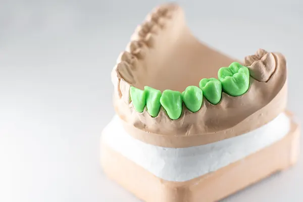 Porcelain Veneers 
