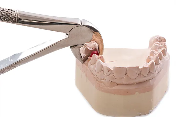 Porcelain Veneers 